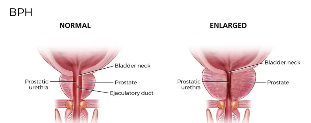 glutathione enlarged prostate Medical Treatment for (BPH) luxury korean sun serum